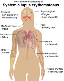 benh lupus trieuchung